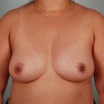 Breast Augmentation Before & After Patient #303