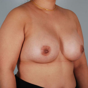 Breast Augmentation Before & After Patient #303