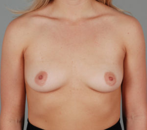 Breast Augmentation Before & After Patient #246