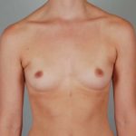 Breast Augmentation Before & After Patient #199