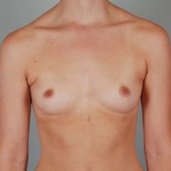 Breast Augmentation Before & After Patient #199
