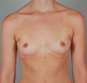 Breast Augmentation Before & After Patient #199