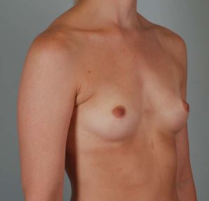 Breast Augmentation Before & After Patient #199