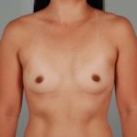 Breast Augmentation Before & After Patient #196