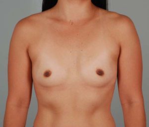 Breast Augmentation Before & After Patient #196