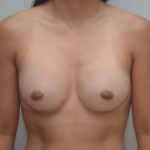 Breast Augmentation Before & After Patient #196