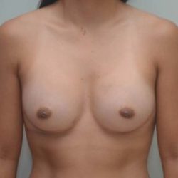 Breast Augmentation Before & After Patient #196