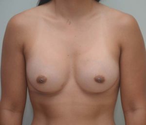 Breast Augmentation Before & After Patient #196