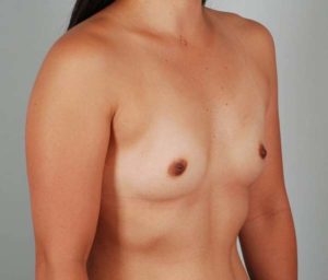 Breast Augmentation Before & After Patient #196