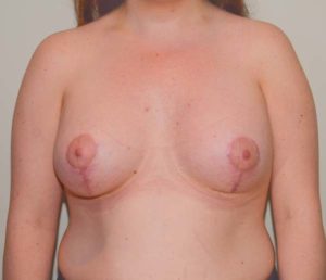 Breast Lift Before & After Patient #897