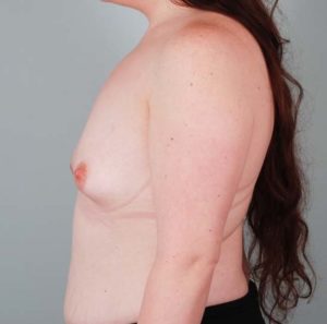 Breast Lift Before & After Patient #897