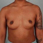 Breast Augmentation Before & After Patient #302