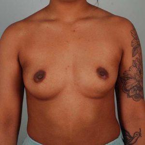 Breast Augmentation Before & After Patient #302