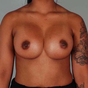 Breast Augmentation Before & After Patient #302