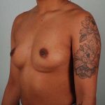 Breast Augmentation Before & After Patient #302