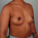 Breast Augmentation Before & After Patient #302