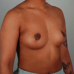 Breast Augmentation Before & After Patient #302