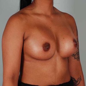 Breast Augmentation Before & After Patient #302