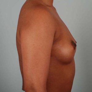 Breast Augmentation Before & After Patient #302