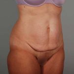 Abdominoplasty Before & After Patient #1330