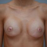 Breast Augmentation Before & After Patient #411