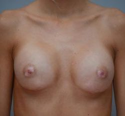 Breast Augmentation Before & After Patient #411