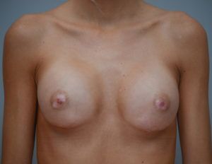 Breast Augmentation Before & After Patient #411