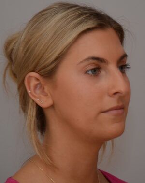 Rhinoplasty Before & After Patient #2115