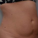 Emsculpt Neo Before & After Patient #2174