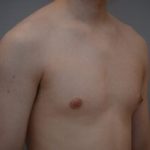 Gynecomastia Before & After Patient #1160