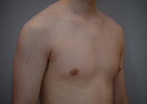 Gynecomastia Before & After Patient #1160