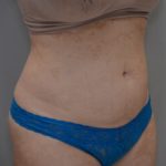 Liposuction with Bodytite Before & After Patient #1558