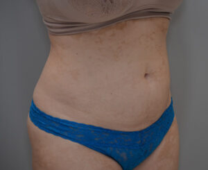 Liposuction with Bodytite Before & After Patient #1558