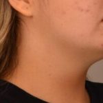 Neck Liposuction Before & After Patient #2007
