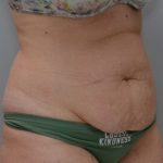 Abdominoplasty Before & After Patient #1496