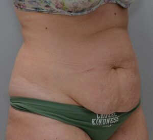 Abdominoplasty Before & After Patient #1496