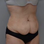 Abdominoplasty Before & After Patient #1495