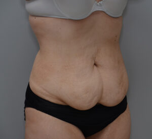 Abdominoplasty Before & After Patient #1495