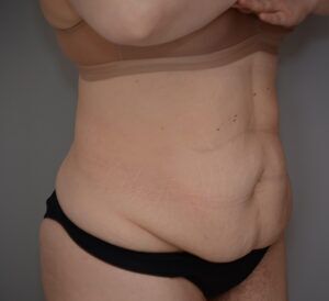 Abdominoplasty Before & After Patient #1494