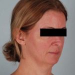 Facelift Before & After Patient #1743
