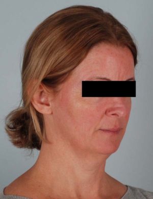 Face And Neck Lift Before & After Patient #1743