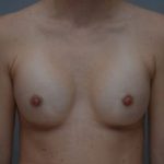 Breast Augmentation Before & After Patient #413