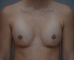 Breast Augmentation Before & After Patient #413