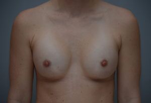 Breast Augmentation Before & After Patient #413