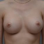 Breast Augmentation Before & After Patient #414