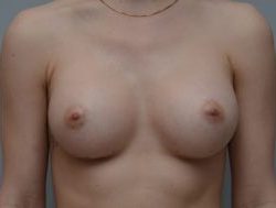 Breast Augmentation Before & After Patient #414