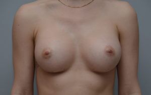 Breast Augmentation Before & After Patient #414