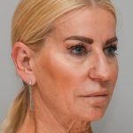 Facelift Before & After Patient #1745
