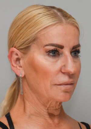 Facelift Before & After Patient #1745