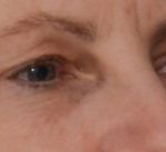 Blepharoplasty Before & After Patient #1704